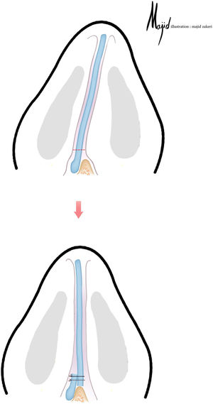 Quando a parte caudal da haste em L é inclinada, a técnica de deslizamento pode ser usada. O enxerto de extensão caudal é geralmente colocado no lado oposto do desvio (Ilustração de Majid Zakeri).