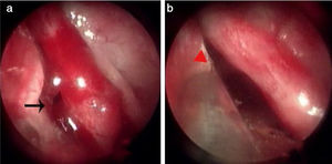 Ponto de sangramento no septo nasal superior. (a) Ponto de sangramento; (b) Zona da MWA. Setas pretas, ponto de sangramento; triângulo vermelho, zona de ablação.