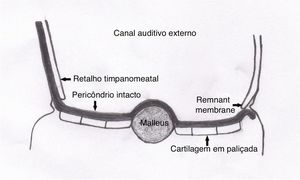 Enxerto colocado com a técnica de underlay de acordo com o retalho timpanomeatal, anel fibroso e remanescente de membrana e a técnica de overlay de acordo com o martelo. O pericôndrio intacto que mantém as paliçadas juntas está voltado para o canal auditivo externo.