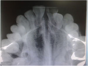 Radiografia com imagem oclusal mostra abertura em leque da sutura média‐palatina no mesmo paciente.