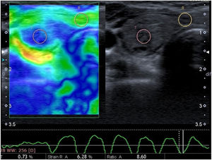 Imagens de ultrassonografia (US) em modo B de tela dupla (direita) e o elastografia por US (esquerda) revelam grandes proporções de regiões azuis que demonstram rigidez, com algumas áreas verdes claras misturadas (escore 3). A média da razão de compressão foi de 8,60. O exame histopatológico revelou carcinoma papilífero da tireoide.