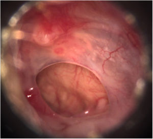 Otoscopia pré‐operatória: perfurações centrais da membrana timpânica, mucosa da cavidade timpânica saudável e ausência de supuração.
