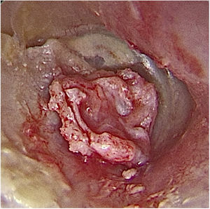 Otoendoscopia intraoperatória: enxerto de cartilagem com sulco inserido na perfuração e pericôndrio em face voltada para o meato acústico externo.