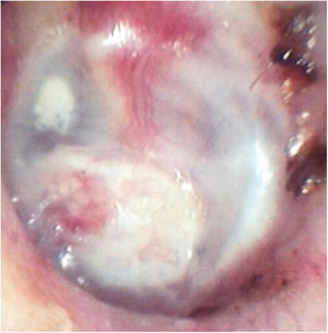 Otoendoscopia no 6° mês pós‐operatório: neotímpano íntegro após adesão do enxerto de cartilagem.