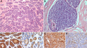 Fotomicrografias representativas do tumor submandibular primário: A e B (Hematoxilina e Eosina, 100x e 400x) mostram um carcinoma adenoide cístico de alto grau, com padrões cribriforme e sólido (esse representa mais de 30% do volume tumoral), com áreas de necrose (*); coloração imuno‐histoquímica para CK7 (C, 200x), PS100 (D, 200x), AML (E, 200x) e CD117 (F, 200x) demonstra a população de células bifásicas característica desse tumor, composta por células ductais e mioepiteliais.