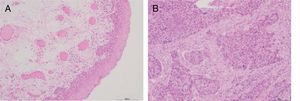 Resultados histopatológicos de pacientes com carcinoma hipofaríngeo (coloração H&E, a barra da escala é de 400μm). A, tecido de pericarcinoma; B, tecido de carcinoma.