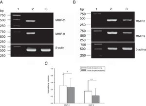 Expressão do mRNA de MMP‐2 e MMP‐9 em tecidos tumorais, tecidos de pericarcinoma e tecidos polipoides de controle obtidos de pacientes com carcinoma hipofaríngeo e pólipo de cordas vocais de pacientes. (A) Expressão representativa de mRNA de MMP‐2 e MMP‐9 em tecidos tumorais e tecidos de controle polipoides. Os tecidos de câncer mostraram uma expressão de mRNA mais intensa de MMP‐2 e MMP‐9, mas quase não houve expressão em tecidos polipoides de controle (faixa 1, 1kb na escada de DNA; faixa 2, tecido de carcinoma; faixa 3, tecido polipoide de controle). (B) Expressão representativa de mRNA de MMP‐2 e MMP‐9 em tecidos tumorais e tecidos de pericarcinoma. Os tecidos cancerígenos mostraram uma expressão de mRNA com nível mais alto de MMP‐2 e MMP‐9 do que os tecidos de pericarcinoma (faixa 1, 1kb na escada de DNA; faixa 2, tecido de carcinoma; faixa 3, tecido de pericarcinoma). (C) Intensidade relativa da expressão de mRNA de MMP‐2 e MMP‐9 em tecidos de carcinoma e de pericarcinoma. Os tecidos de carcinoma exibiram níveis mais altos de expressão de mRNA de MMP‐2 e MMP‐9 do que os tecidos de pericarcinoma. (* p <0,05 e ** p <0,01).
