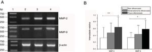 Expressão de mRNA de MMP‐2 e MMP‐9 em tecidos tumorais de diferentes estágios histopatológicos obtidos de pacientes com carcinoma hipofaríngeo. (A) Expressão representativa de mRNA de MMP‐2 e MMP‐9 em tecidos tumorais de diferentes estágios patológicos. A expressão de MMP‐2 e MMP‐9 foi reduzida com a melhora do grau de diferenciação (faixa 1, 1kb na escada de DNA; faixa 2, paciente bem diferenciado; faixa 3, paciente moderadamente diferenciado; faixa 4, paciente pouco diferenciado); (B) Intensidade relativa da expressão do mRNA de MMP‐2 e MMP‐9 em tecidos tumorais de diferentes estágios histopatológicos. Pacientes pouco diferenciados exibiram níveis mais altos de expressão de mRNA de MMP‐2 e MMP‐9 do que pacientes bem diferenciados (*p <0,05 e ** p <0,01).