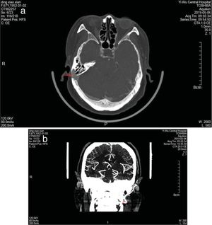 A venografia por tomografia computadorizada revelou o divertículo na superfície lateral do seio sigmoide direito e um defeito no córtex mastoideo (seta vermelha) (a). Compressão da veia jugular interna pelo processo estiloide (seta vermelha) (b).