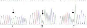 Resultados do sequenciamento de DNA do polimorfismo rs7078160. (A) Genótipo homozigoto AA mutado. (B) Genótipo heterozigoto AG. (C) Genótipo homozigoto GG selvagem.