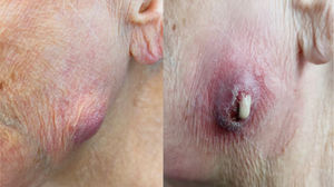 Edema da parótida anterior esquerda e mandíbula superior (imagem à esquerda) e úlcera cutânea com drenagem purulenta proveniente da glândula parótida acessória esquerda (imagem à direita).