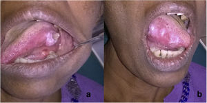 (a) Lesões ulcerativas na borda lateral da língua. (b) Lesões múltiplas no outro lado da língua.