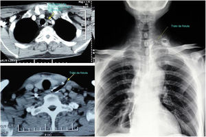 Exame de ressonância magnética/tomografia computadorizada com contraste e exame com deglutição de bário demonstraram um trato fistuloso do sítio anastomótico até a lateral do pescoço com linfonodos aumentados encontrados no nível IV.