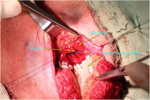 O defeito do sítio anastomótico foi reparado com a camada de pele com o lado cutâneo voltado para o lúmen.