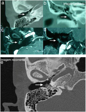 TC e RM do osso temporal do Caso 3. As imagens a, b, c, d mostraram que a lesão estava localizada no meso‐ e no hipotímpano com encapsulamento da cadeia ossicular na TC do osso temporal (a, axial; b, coronal), mostrava aumento moderado com administração de gadolínio na RM (c, axial; d, coronal). A imagem “e” mostrou recidiva do tumor na TC de alta resolução do osso temporal (e, axial) e a presença de massa que demostrava isointensidade, localizada na membrana timpânica, sem erosão óssea.
