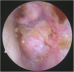 Imagem otoscópica do Caso 6. Demonstrou a presença de uma lesão rosada hipervascular e não pulsátil, projetava‐se para o canal auditivo externo.