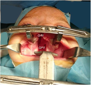 Medida do gap alveolar (GA) e gap palatino (GP) na primeira cirurgia.
