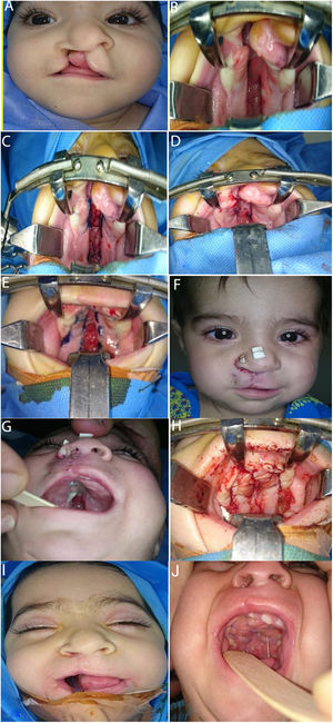 Criança do sexo feminino, com seis meses, apresentou fenda labial completa e fenda palatina do lado direito; (A) no pré‐operatório, (B) a (D) marcação e inserção do retalho do vômer, (E) e (F) cinco dias após a cirurgia, (G) a (I) segunda etapa do reparo palatino completo após 3 meses, (J) cinco dias após a segunda cirurgia.