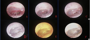 Processo de cicatrização de grandes perfurações após a aplicação tópica de ofloxacina gotas otológicas: 1° após a perfuração (A) e 4 dias (B), 7 dias após o tratamento (C) e 2 semanas (D), 3 semanas (E) e 7 semanas após o tratamento (F).