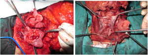 (a–b) Tumores ressecados por faringotomia combinada lateral e infra‐hióidea.