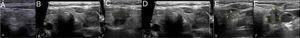 Diagnósticos por ultrassonografia em escala de cinza de nódulos da tireoide. A, hipoecogenicidade mais baixa em comparação à musculatura adjacente, B, microlobulado, C, margens irregulares, D, microcalcificações, E, calcificações mistas, F, formato mais alto do que largo em maior dimensão anteroposterior.