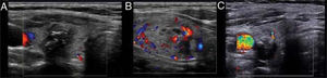 Diagnóstico por ultrassonografia com doppler colorido subjetivo. A, avascularidade; B, vascularidade ≤ 25% da circunferência do nódulo; C, o padrão de fluxo é maior do que o da parte circundante.