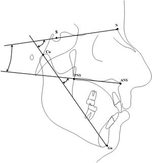 Traçado que mostra as variáveis cefalométricas usadas no presente estudo. S, ponto de sela; N, ponto de násio; ANS, espinha nasal anterior; PNS, espinha nasal posterior; Co, ponto de côndilo; Gn, ponto de gnático.