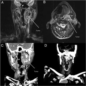 (A–B) Imagens de ressonância magnética do paciente nos planos axial (A) e coronal (B). (C) Imagens de tomografia computadorizada do paciente no plano coronal. (D) Imagens de angiografia do paciente no plano coronal.