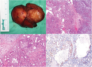 (a) Visão macroscópica do tumor. (b) Infiltrado tumoral progredindo no padrão glandular do estroma hialinizado, adjacente ao parênquima do adenoma pleomórfico contendo a matriz condromixoide (H&E, 10×). (c) Glândulas cribriformes contendo áreas de necrose de comedo em seu lúmen (H&E, 10×). (d) Coloração de receptor de andrógeno nuclear em células tumorais (20×).