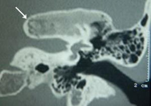 Tomografia de ossos temporais, corte coronal, lado esquerdo. A seta indica displasia fibrosa monostótica restrita à porção petrosa.