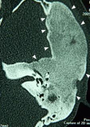 Tomografia de ossos temporais, corte axial, lado esquerdo. Cabeças de seta: Displasia fibrosa monostótica, com extensão para todas as porções do osso temporal e restrita às suas suturas.