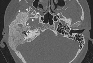 Tomografia de ossos temporais, corte axial. Displasia fibrosa poliostótica do osso temporal à direita. As cabeças de seta indicam extensão para a asa maior do esfenoide.