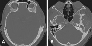 Tomografia de ossos temporais, cortes axiais. (A) Ressecção parcial da porção escamosa e parietal à esquerda. (B) Evolução com colesteatoma nas porções mastoidea e timpanal ipsilateral.