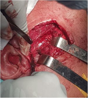 Aspecto perioperatório dos tumores. Na dissecção da glândula parótida esquerda, o tumor é identificado em sua origem, na base do processo estiloide.