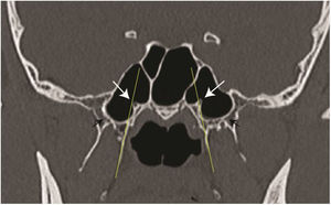 Tomografia computadorizada (TC) coronal mostra a posição do canal vidiano (seta branca) no mesmo plano da placa pterigoide medial (linha fina amarela) no lado esquerdo e medial a esse plano no lado direito. As setas pretas indicam a placa pterigoide pneumatizada.