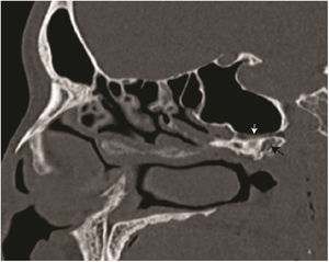 Reconstrução sagital de tomografia computadorizada mostra o canal vidiano (seta branca) e processo pterigoide pneumatizado (seta preta).