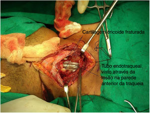 Cartilagem cricoide fraturada e lesão na parede traqueal anterior.