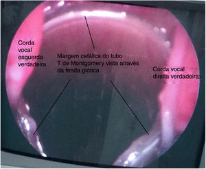 Margem superior da porção vertical do tubo T de Montgomery, vista através das cordas vocais na laringoscopia direta/flexível.