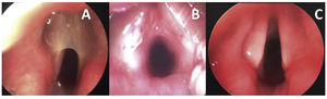 Caso 1 – Membrana laríngea do tipo II (A) Imagem intraoperatória antes da incisão na membrana; (B) estenose subglótica revelada após incisão na membrana; (C) Visão endoscópica pós‐operatória.
