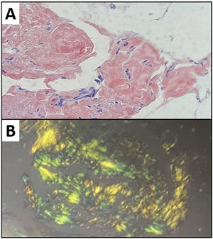 Biópsia de laringe. (A) H&E. 40x: extenso depósito de material amiloide no córion; (B) Vermelho Congo.