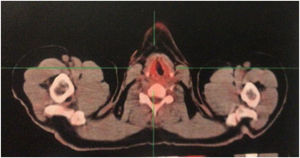 PET‐CT, corte axial da região do pescoço. Discreta radioconcentração assimétrica.