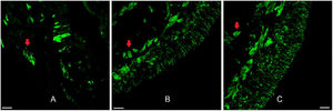 Epitélio olfatório humano. Imunofluorescência do epitélio olfatório humano adequado para análise morfológica em biópsia do septo nasal superior com marcação neuronal. Na figura A, vemos a marcação de anticorpo anti‐proteína marcadora olfatória (OMP 1:100, para neurônios olfatórios maduros). Nas figuras B e C usou‐se o marcador anti‐beta tubulina III (β3 1:100, total, para neurônios maduros e imaturos). As setas vermelhas indicam a presença de feixes nervosos. Barra de escala com 25μm.