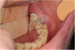 Imagem mostra OMAM Estágio 2, que ocorreu após exodontia e foi incluído no estudo.