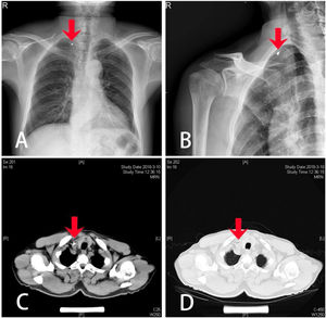 Imagem pré‐operatória: (A) Radiografia de tórax frontal; (B) Radiografia da articulação clavicular tangencial; (C) TC de tórax simples (janela do mediastino); (D) TC de tórax simples (janela pulmonar); (seta vermelha que aponta para o corpo estranho).