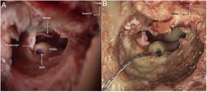 A, Visão intraoperatória da MJR no osso temporal esquerdo de ovelha. B, Arranjo de eletrodos completamente inserido na MJR na cóclea esquerda de uma ovelha. MJR, Membrana da janela redonda; CAE, Canal auditivo externo.