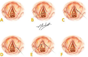 Representação do procedimento cirúrgico em pregas vocais humanas: (A) visão endoscópica de PVs; (B) incisão na face superior de toda extensão da PV; (C) descolamento da mucosa; (D) secção da mucosa; (E) retalho pediculado com CF no ligamento vocal; (F) reposicionamento do retalho sobre o ligamento vocal. Arte de Burchianti LC.