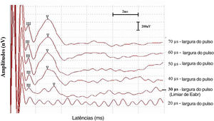 Exemplo de limiar do eABR registrado para o indivíduo 6 durante a cirurgia de implante coclear. O limiar de eABR foi definido como a largura de pulso mais baixa na qual a onda V pode ser detectada (30μs).
