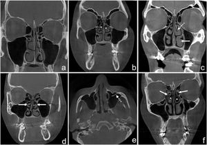 Imagens de TCFC de variações anatômicas nasossinusais. Ângulo de desvio septal (a); CB bilateral (asterisco) (b); Hipertrofia da concha média (HCM) (seta tracejada), hipertrofia da concha inferior (HCI) (seta branca) (c); Concha Média Paradoxal (CMP) Bilateral (setas brancas) (d); presença de septos no seio maxilar (seta tracejada) (e); Pneumatização do Processo Uncinado (PPU) bilateral (setas brancas) e CB (asterisco) (f).