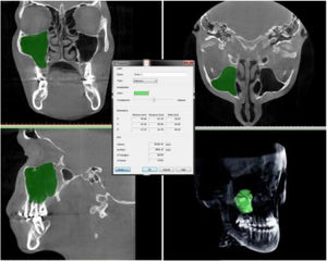 Reconstrução em 3D do volume do seio maxilar.