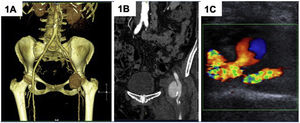 A-B) Caeo 1. CT angiography shows at the level of the left common femoral artery a large FAP of 5.3cm maximum diameter with communication with the neckless artery. C) Case 2. Arterial Doppler shows a small collection of 1.5cm in diameter medial to the right distal common femoral artery; it presents filling with back-and-forth arterial flow and has a short neck.